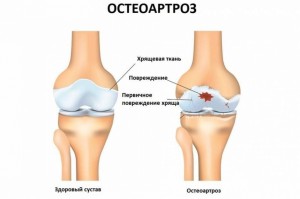Лечение остеоартроза: лучшие профилактические меры